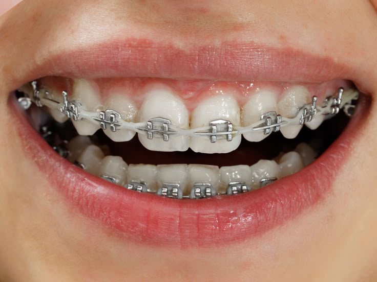 Damon Braces