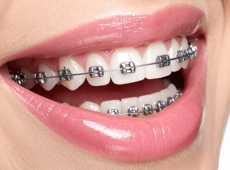 Ceramic Braces