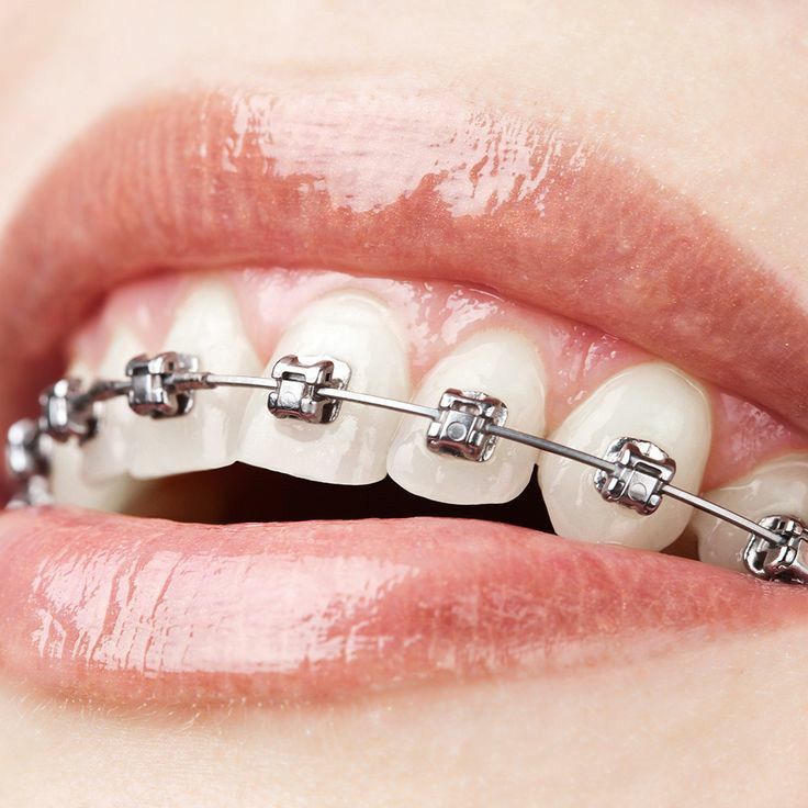 Metal Braces